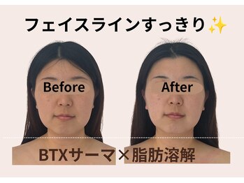 ナースリフェイス(Nurse Reface)/顔を小さくしたい