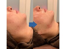 ピュアトゥルー 岐阜西店(PureTrue)/フェイスラインも綺麗に！