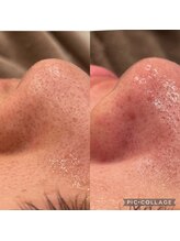 アトリエ ハルミナ(atelier harumina)/毛穴ケア・毛穴洗浄　三島エステ