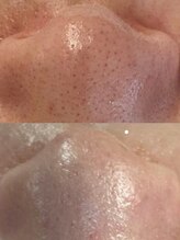 ナチュライズ(NatuRise)/毛穴ケアにハーブピーリング