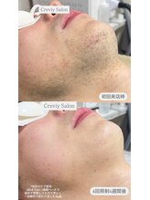 クレヴィー(Creviy)/ヒゲ脱毛