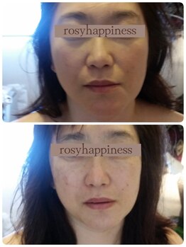 ロージーハピネス(Rosy happiness)/アキュライズ施術2回