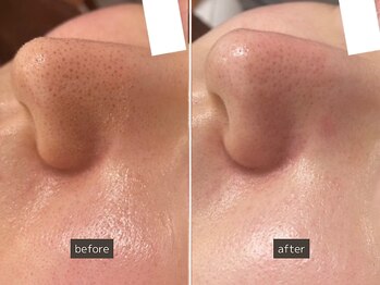 SEC(Shizuoka esthetic company)/【毛穴】黒ずみ/詰まり