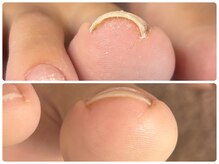 寺子屋ビューティーズ(寺子屋Beauty's)/【巻き爪】　こんなに綺麗に☆