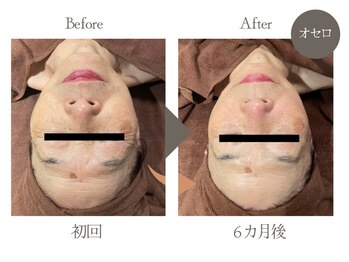 ビューティーリバース 関内店/シミケア美白!オセロマシン