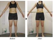 ビューティークリニックコダマ 宮崎本店/【2か月コース】A.K様（21歳）