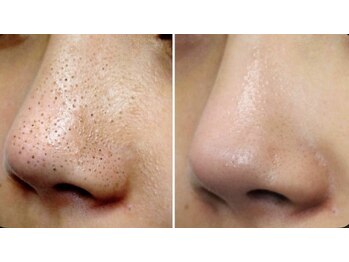 BUB 立川/毛穴洗浄で黒ずみスッキリ