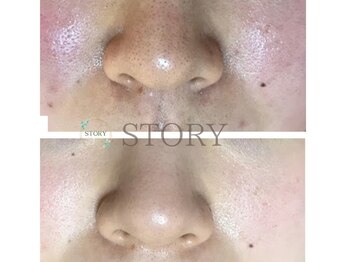 ストーリー(STORY)/ハーブピーリング専門店STORY