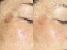 ベル 桜木町(Belle)/ハーブピーリング｜ニキビケア