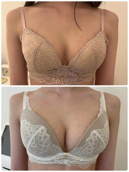 美人バスト 本厚木店/バストアップ◇症例◇