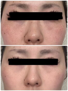 ツヤハダコガオ 千葉店/before⇒after 【シミケア】