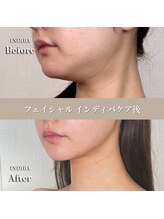 術後の女神 大阪本町店/ダウンタイムケア・インディバ