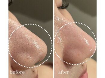 アイビーケア 三田(ivy care)の写真/肌質改善したい方へ｜ハーブピーリングで毛穴すっきり土台ケア