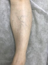 ナノハナ/鹿沼市の全身脱毛のナノハナ