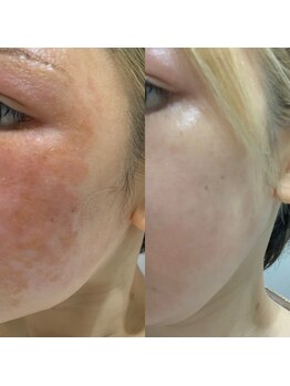 エヌエー(na)/急なお肌トラブル・肌荒れ改善