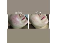 ビークレアーズ ビビ(B-crears. ViVi)の雰囲気（改善症例が大多数あるハーブピーリングもご用意。）