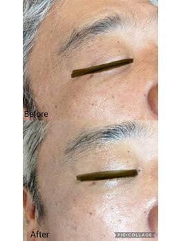 ブリス(Bliss)/ハーブトリートメント3g1回