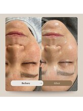 ヒュウ(hue.)/韓国発最新肌管理[セルマン]