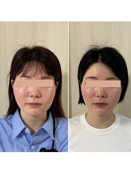 サロン ウェル(SALON WELL)/【20代 小顔矯正/頬骨矯正】