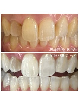 ホワイトニングルーム 横浜店(Whitening Room)/ホワイトニング/横浜