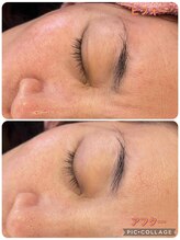 サロンドラニ(salon de LANI)/【プラズマフェイシャル】症例