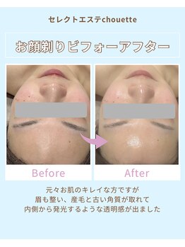 セレクトエステ シュエット(chouette)/フェイスシェーブbefore after
