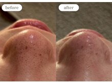 リスタ(RSTA)/【BEFORE/AFTER】