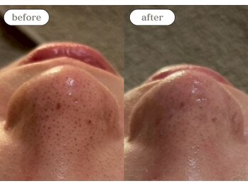 リスタ(RSTA)/【BEFORE/AFTER】