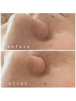 メナードフェイシャルサロン 岐阜茜部/紫外線対策/美白ケア/しみケア