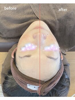 エスサロン(S.salon)/超音波による小顔効果