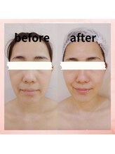 ブライトサロン(Bright Salon)/小顔＆リフトアップも期待大！