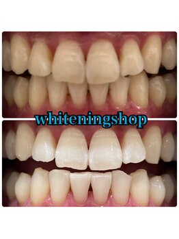 ホワイトニングショップ 武蔵小杉店/武蔵小杉ホワイトニング美白ケア