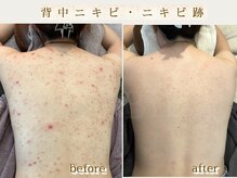 ホウビ(HOUBIE)の雰囲気（《背中ニキビを得意とする専門サロンHOUIBEにお任せ下さい！）