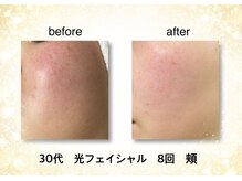 KMB 恵比寿店/光フェイシャル効果