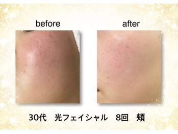 KMB 恵比寿店/光フェイシャル効果