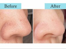 プレステージ 川崎店/◆水素ピーリング　Before/After