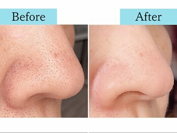 プレステージ 川崎店/◆水素ピーリング　Before/After