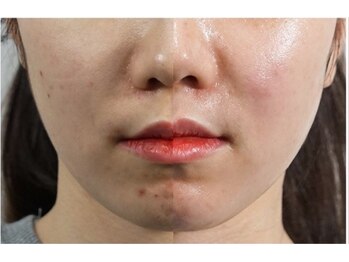 ルアナ 柏店(LUANA)/ララピール【before・afuter】