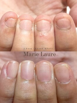 マリーロール 淀屋橋本店(Marie Laure)/自爪育成/深爪矯正/ネイルケア