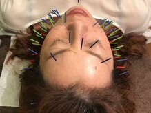 カナヤ鍼灸整骨院/本数追加で一気にリフトアップ♪