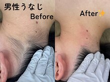 アンビー(Ambee)/追加メニュー／ワックス脱毛