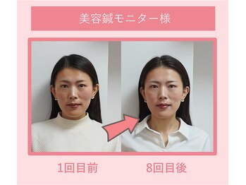 グリーンノア鍼灸院/40代女性美容鍼8回目の変化