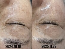 ビーマジック(Be Magic)/毛穴/毛穴洗浄/ピーリング/眉毛