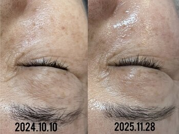 ビーマジック(Be Magic)/毛穴/毛穴洗浄/ピーリング/眉毛