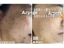 アルページュ(Arpege)の雰囲気（Arpegeの肌管理♪最速ニキビケア#シミケア★肌の内側から変化へ）