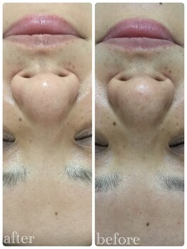 メイユール(MEILLEUR)/光フェイシャル