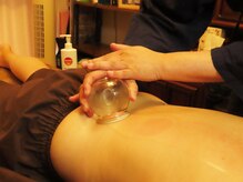 推拿處はりきゅあ はりきゅあ子宝院/カッピング