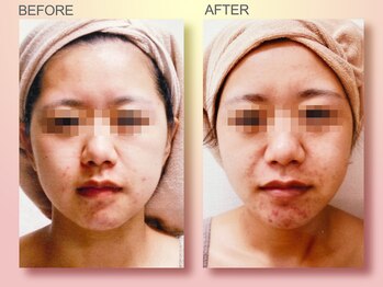 ジュリア オージェ 難波店/ビフォーアフター（小顔)