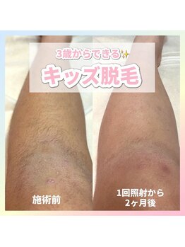 サロン(SALON)/キッズ脱毛：脚