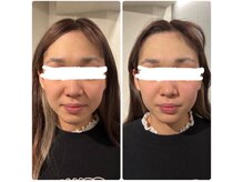 ネオファースト 大阪福島店(NeoFirst)/法令線もお任せ下さい！#毛穴